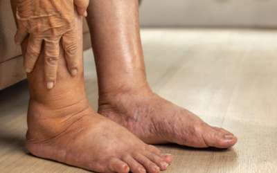 Pie Diabético: cómo evitar amputaciones con diagnóstico vascular oportuno