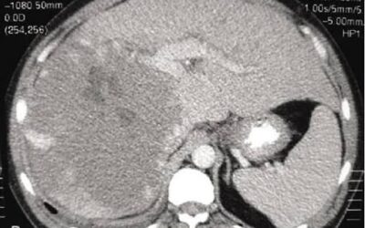 ¿Por qué una Tomografía Computarizada (TAC) puede salvar tu vida?
