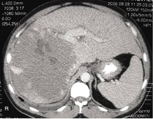 ¿Por qué una Tomografía Computarizada (TAC) puede salvar tu vida?