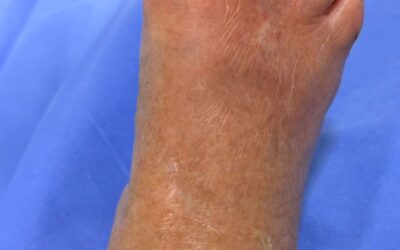 Pie Diabético: cómo evitar amputaciones con diagnóstico vascular oportuno